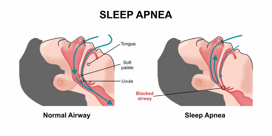 Sleep apnea