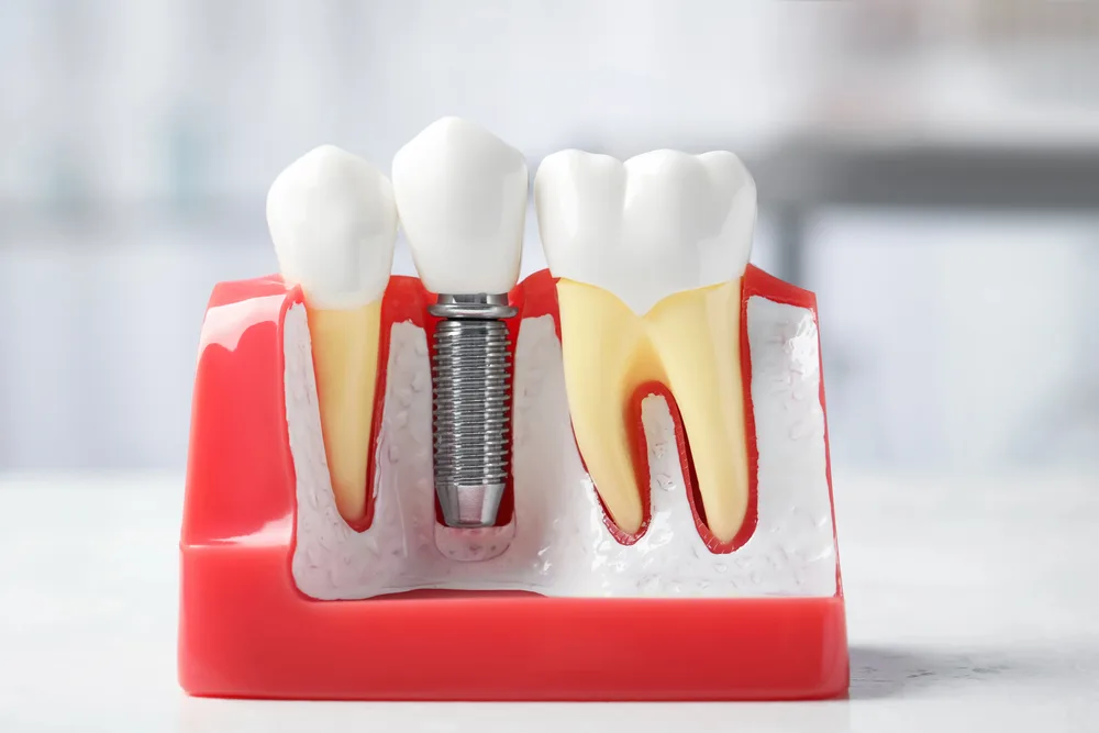 implante dental entre diente